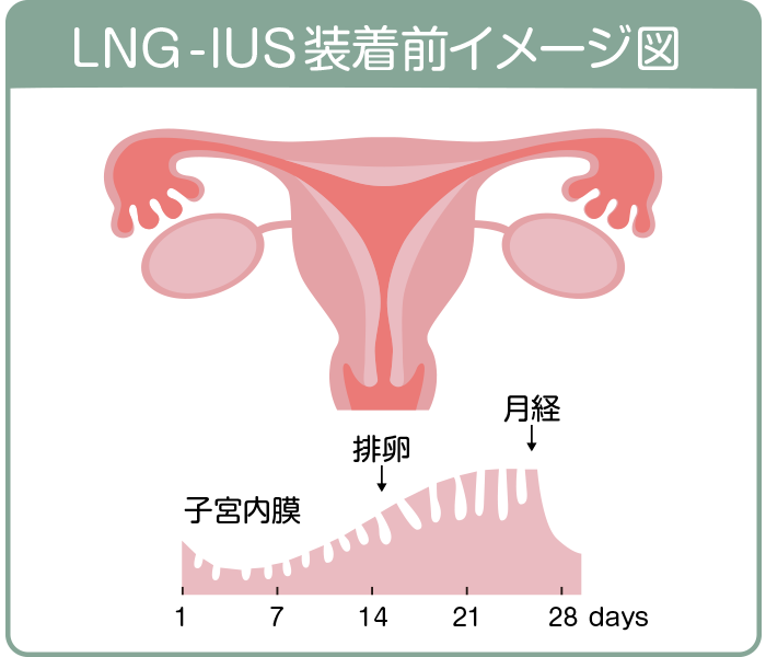 子宮腺筋症|LNG-IUS装着前イメージ図
