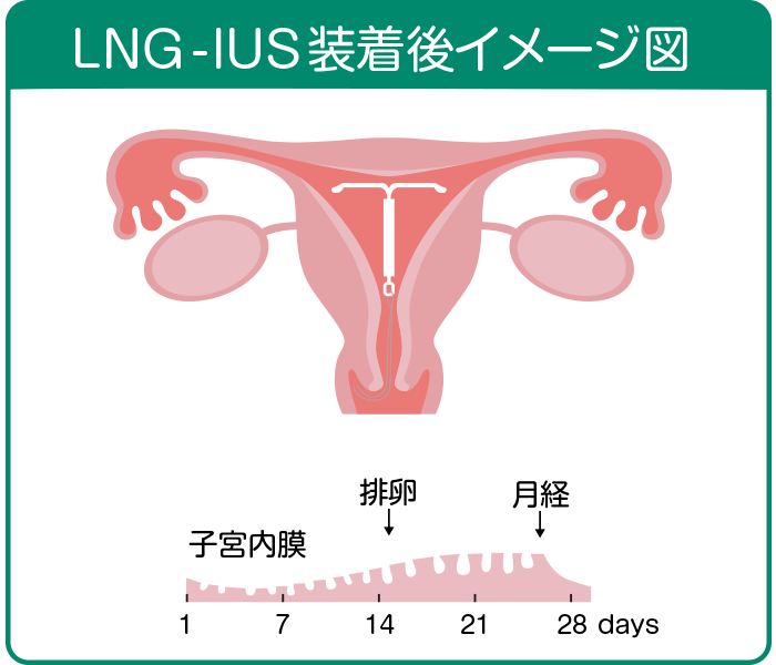 子宮腺筋症|LNG-IUS装着後イメージ図