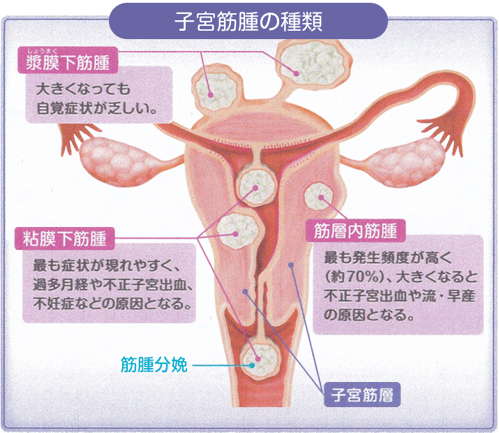 婦人科診療|子宮筋腫の種類