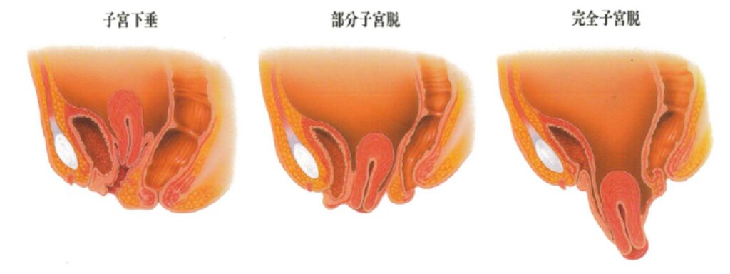 子宮脱