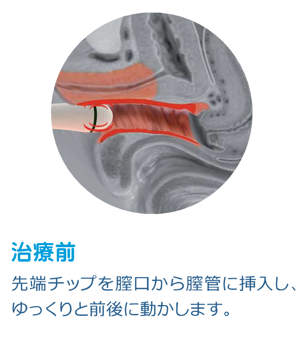 ウルトラフェミー360|治療前