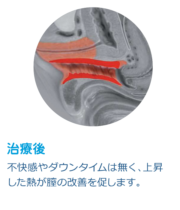 ウルトラフェミー360|治療後